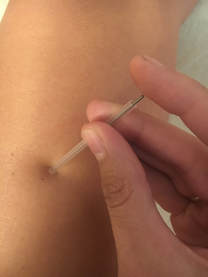 Picture of acupuncture needle